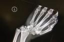 An X-Ray of Jason Ikin's hand